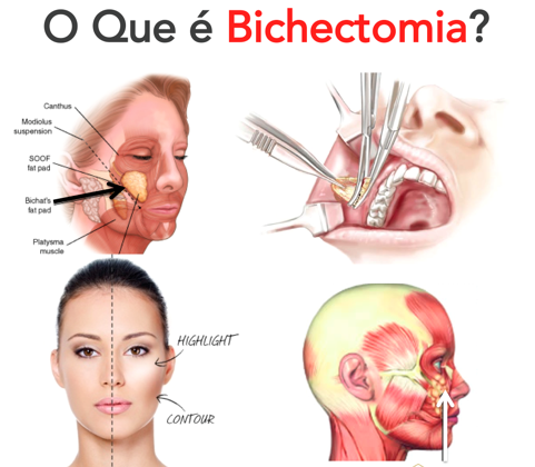 O que é bichectomia? 